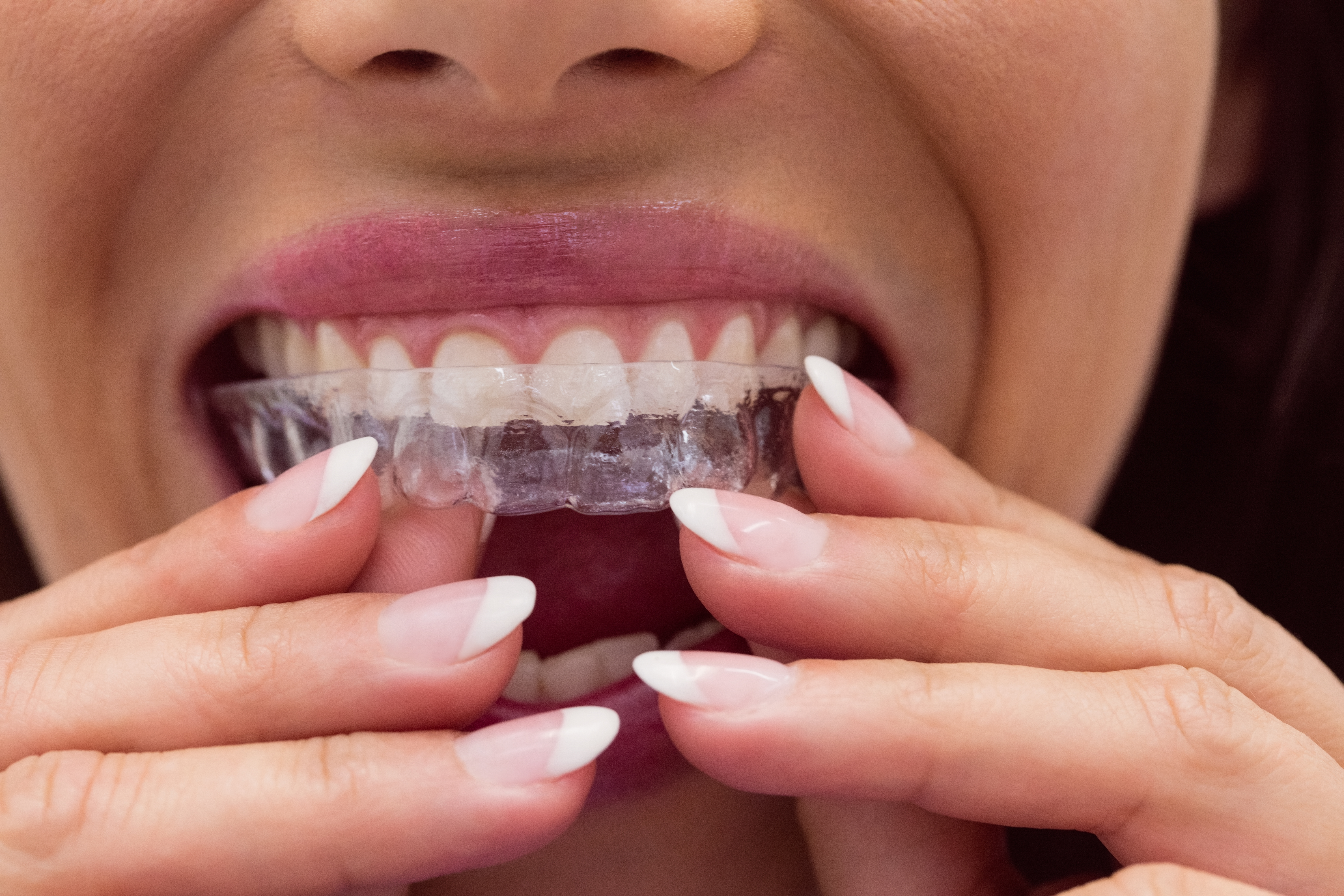 Patient holding clear aligner tray